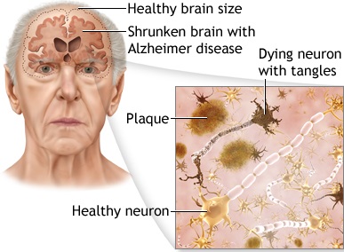 What Causes Alzheimer’s Disease?